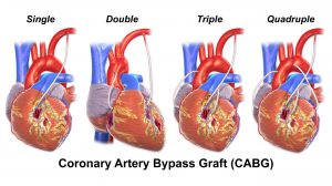 Bypass Coronario