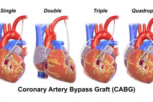 Bypass Coronario